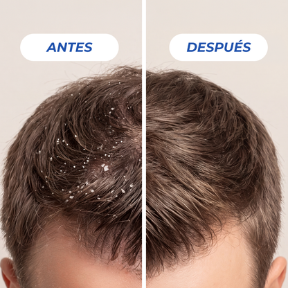 Shampoo Anticaspa Grasa ICE 300 ml